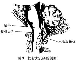 最常见的是颅中凹的颞叶海马沟回疝入小脑幕裂隙,形成小脑幕切迹疝