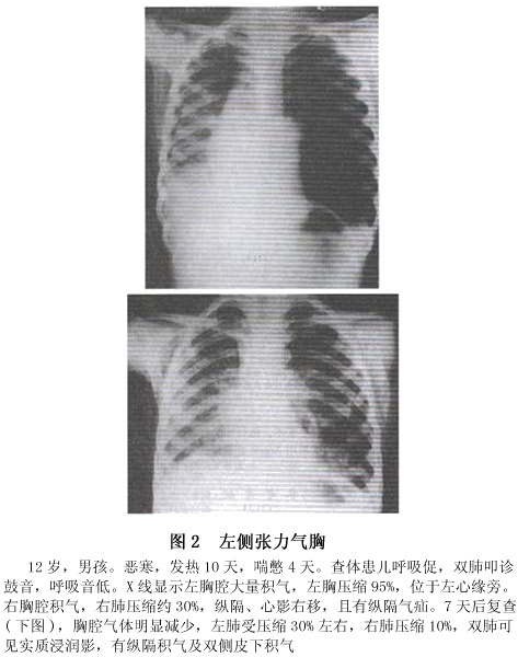 小儿气胸