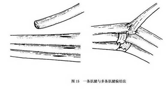 b.粗细直径不等的肌腱也可应用编织缝合(图16).