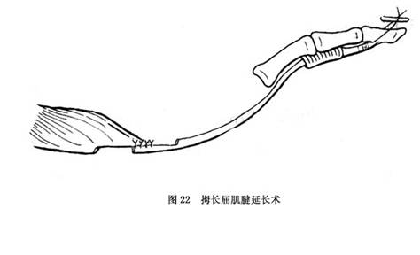 ②环指浅屈肌腱移位术:指浅屈肌与拇长屈肌为协同肌.