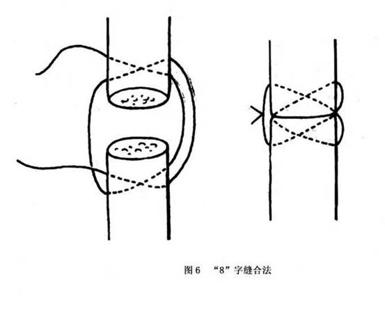 此方法操作简便,肌腱缝合处抗张力较弱.