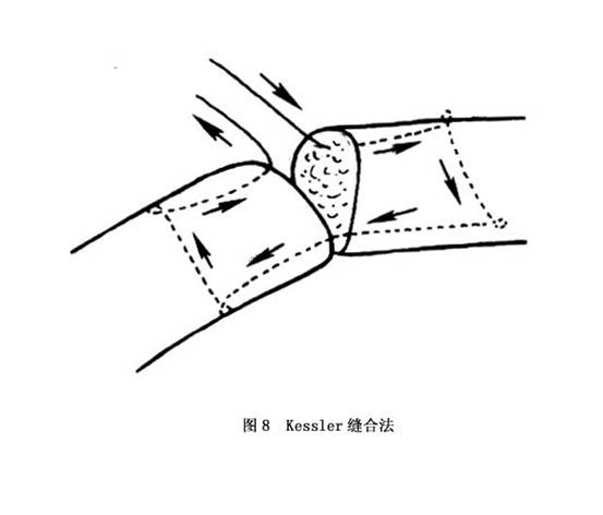 d.kessler缝合法:用双直针,涤纶丝线(5-0)缝合,如图所示(图8).