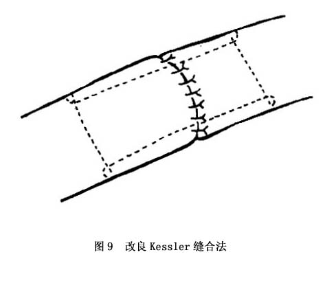 改良kessler方法,在原方法的基础上,肌腱缝合处加缝一圈间断缝合