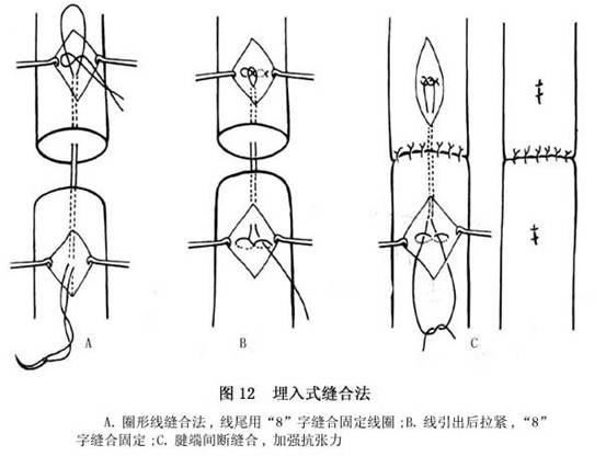 进针和出针处的线圈均用"8"字缝合固定,大部分缝合线嵌入肌腱内(图12)