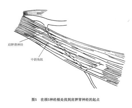 肩胛背神经卡