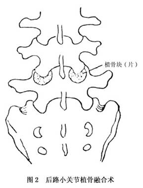 肥大性脊椎炎