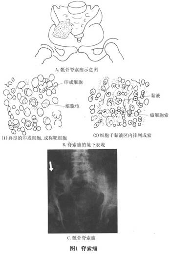 x线检查 x线平片显示肿瘤以溶骨性破坏为主,不见钙化及骨化.