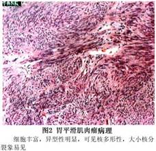 平滑肌肉瘤与良性平滑肌瘤的区别,单是肿瘤的大小难于作为判断其