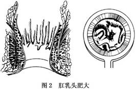 肛窦炎及肛乳头炎