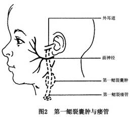 鳃裂囊肿和瘘管