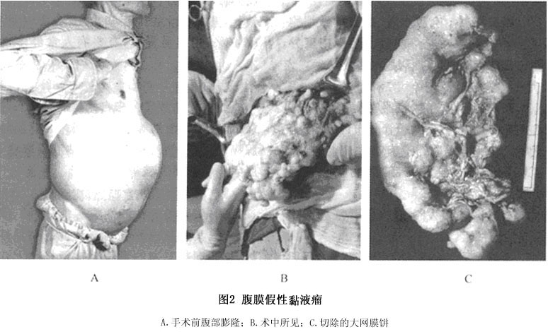 腹膜假黏液瘤