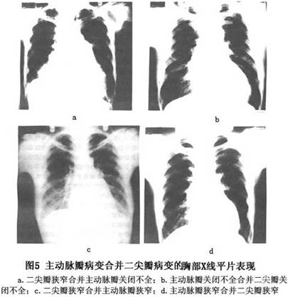 (3)当二尖瓣和主动脉瓣均为关闭不全时:左室扩大和肥厚显著,左室