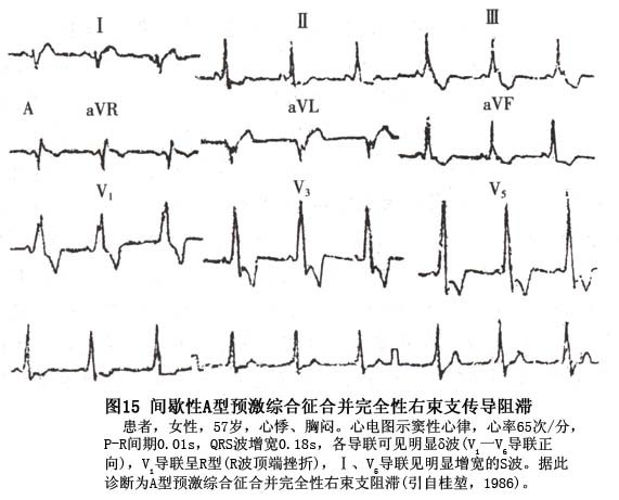 典型预激综合征