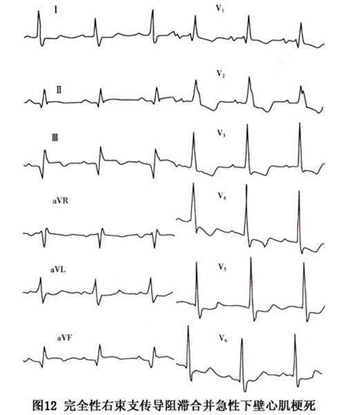 右束支传导阻滞_右束支传导阻滞的症状_右束支传导_导