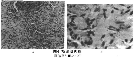 眼眶横纹肌肉瘤