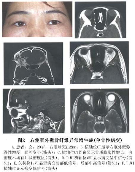 眼眶骨纤维异常增殖症