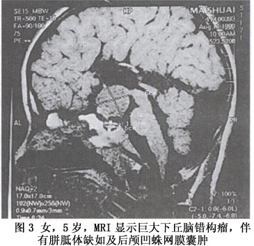 下丘脑错构瘤