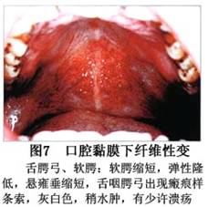 口腔黏膜下纤维化