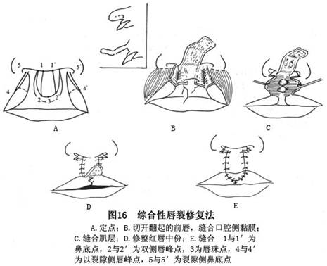     综合性双侧唇裂修复法(图16)