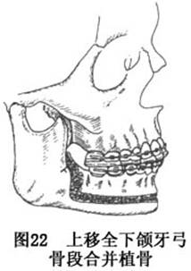 牙颌面畸形_牙颌面畸形的症状_牙颌面畸形治疗_导医网