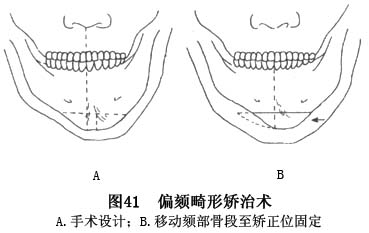 对颏部前后向发育不足所致后缩畸形,但下颌颏高度(上下距)过大的病例