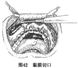 切口:在上颌口腔前庭沟顶唇侧唇颊黏膜部,起自一侧颧牙槽嵴对应处,沿