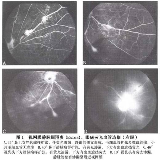 视网膜静脉周围炎