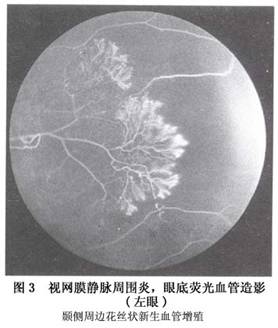 视网膜静脉周围炎