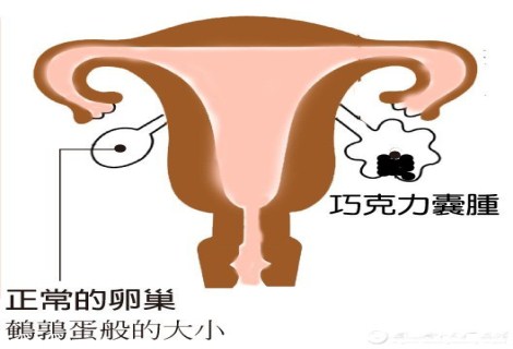 卵巢巧克力囊肿破裂独有的特点